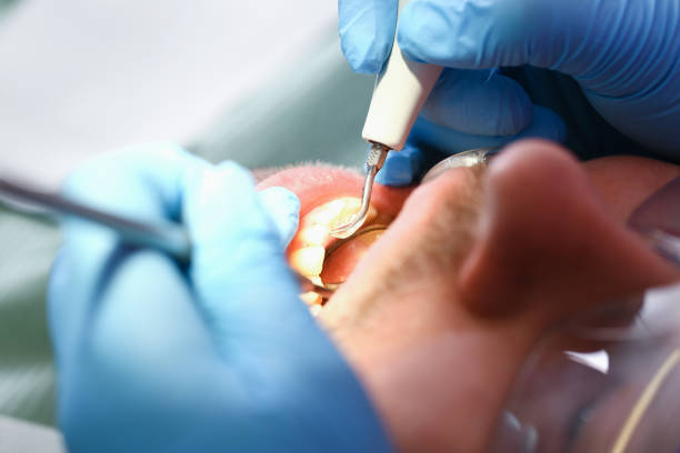 Best Emergency Dentist for Knocked-Out Tooth in Hamilton, OH